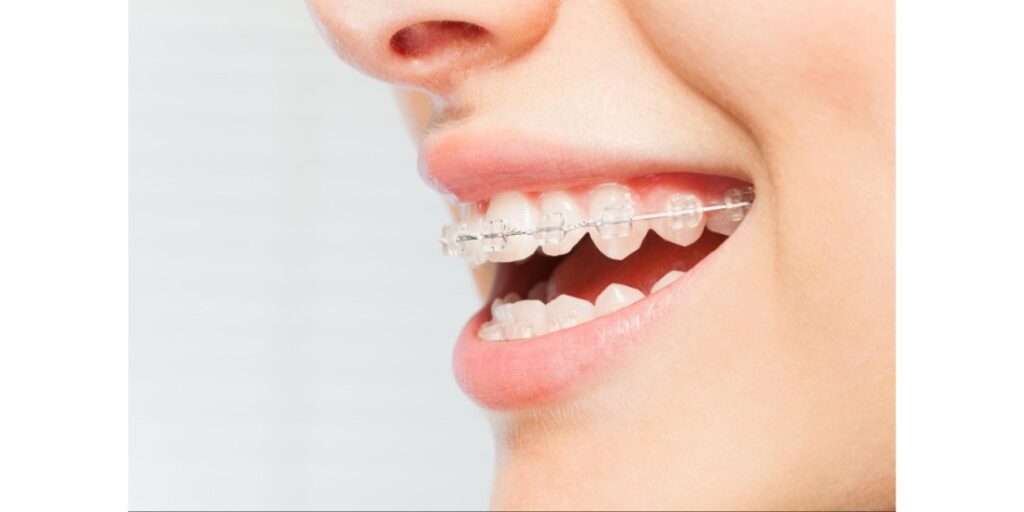 Why Teens Should Get Orthodontic Treatment